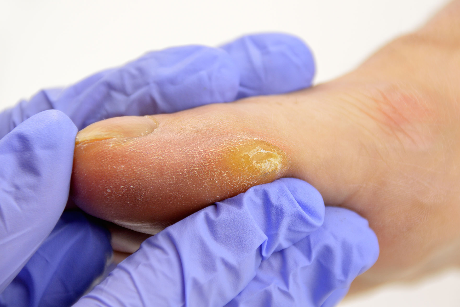 Premiere Pointe Podiatry | Corns   Calluses, Sports Medicine and Hammertoes