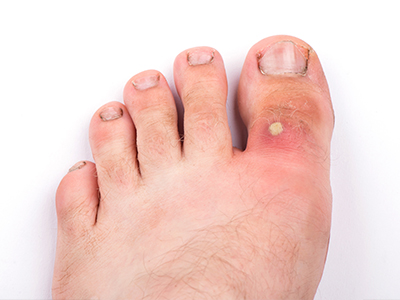 Premiere Pointe Podiatry | Bunions, Diabetic Foot Care and Fungal Nails