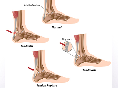 Premiere Pointe Podiatry | Ankle   Foot Fractures, Corns   Calluses and Ankle Sprains