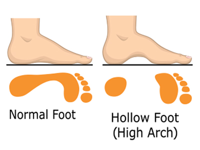 Premiere Pointe Podiatry | Ankle   Foot Fractures, Fungal Nails and Minimally Invasive Surgery