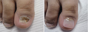 Premiere Pointe Podiatry | Wound Care, Bunions and Minimally Invasive Surgery